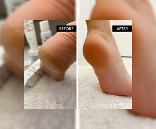 Refeet foot bath salt with 45% urea