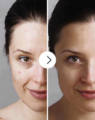 Derminax tablets with zinc and vitamins C, E and B2 for acne, blemishes and imperfections_3 - 3