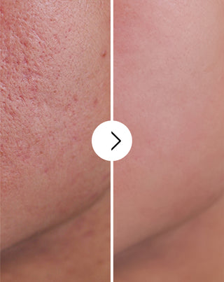 Derminax tablets with zinc and vitamins C, E and B2 for acne, blemishes and imperfections