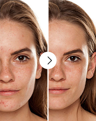 Derminax tablets with zinc and vitamins C, E and B2 for acne, blemishes and imperfections_2 - 2