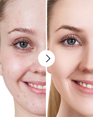 Derminax tablets with zinc and vitamins C, E and B2 for acne, blemishes and imperfections_5 - 5