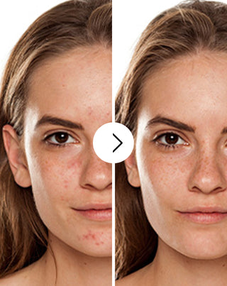 Derminax tablets with zinc and vitamins C, E and B2 for acne, blemishes and imperfections_2 - 2