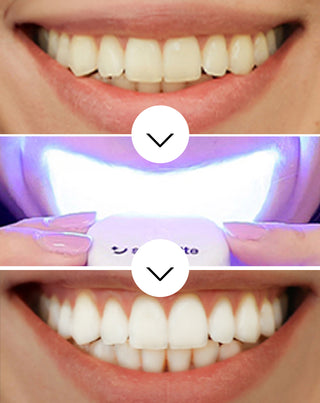 Teeth whitening kit with LED lamp and Light & Bright Smilebite whitening gel - 3